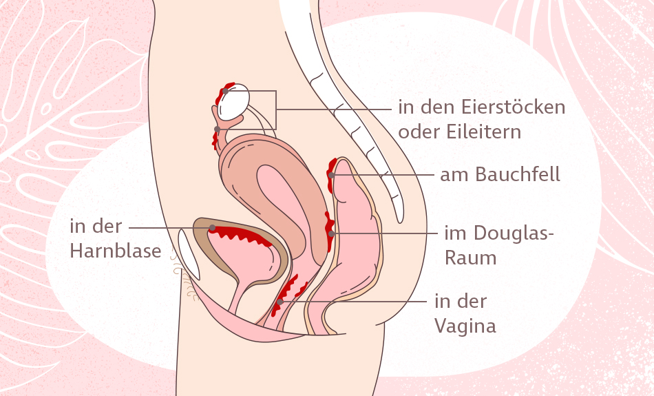 Endometriose-Herde