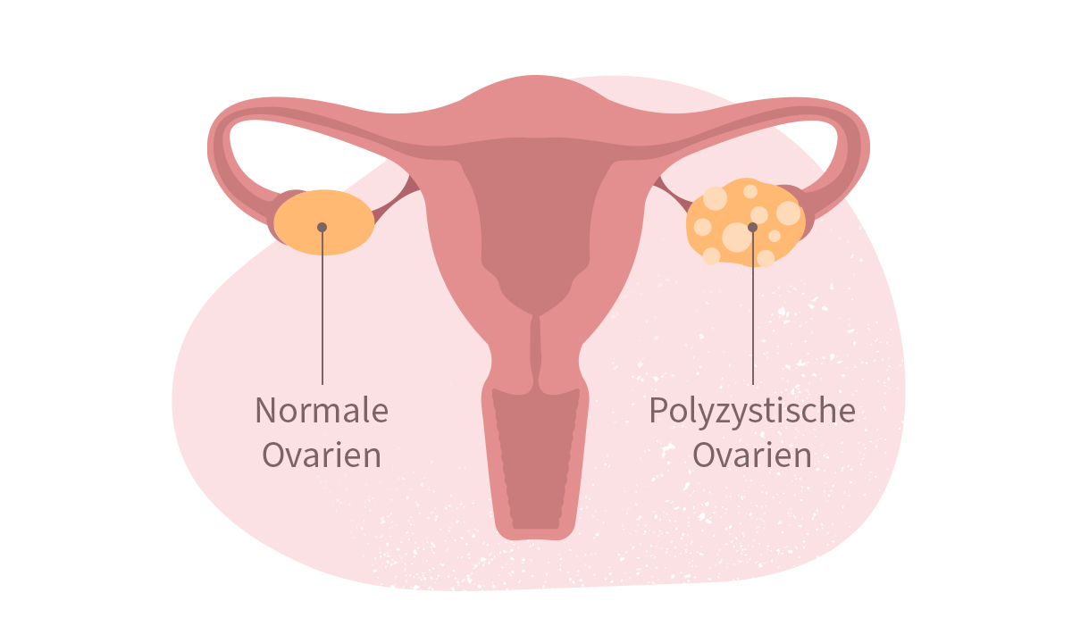 Grafik Gebärmutter und Eierstöcke mit PCOS
