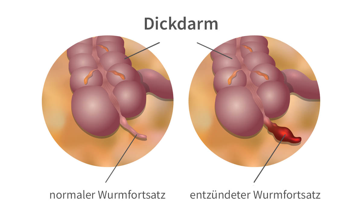 Wurmfortsatz