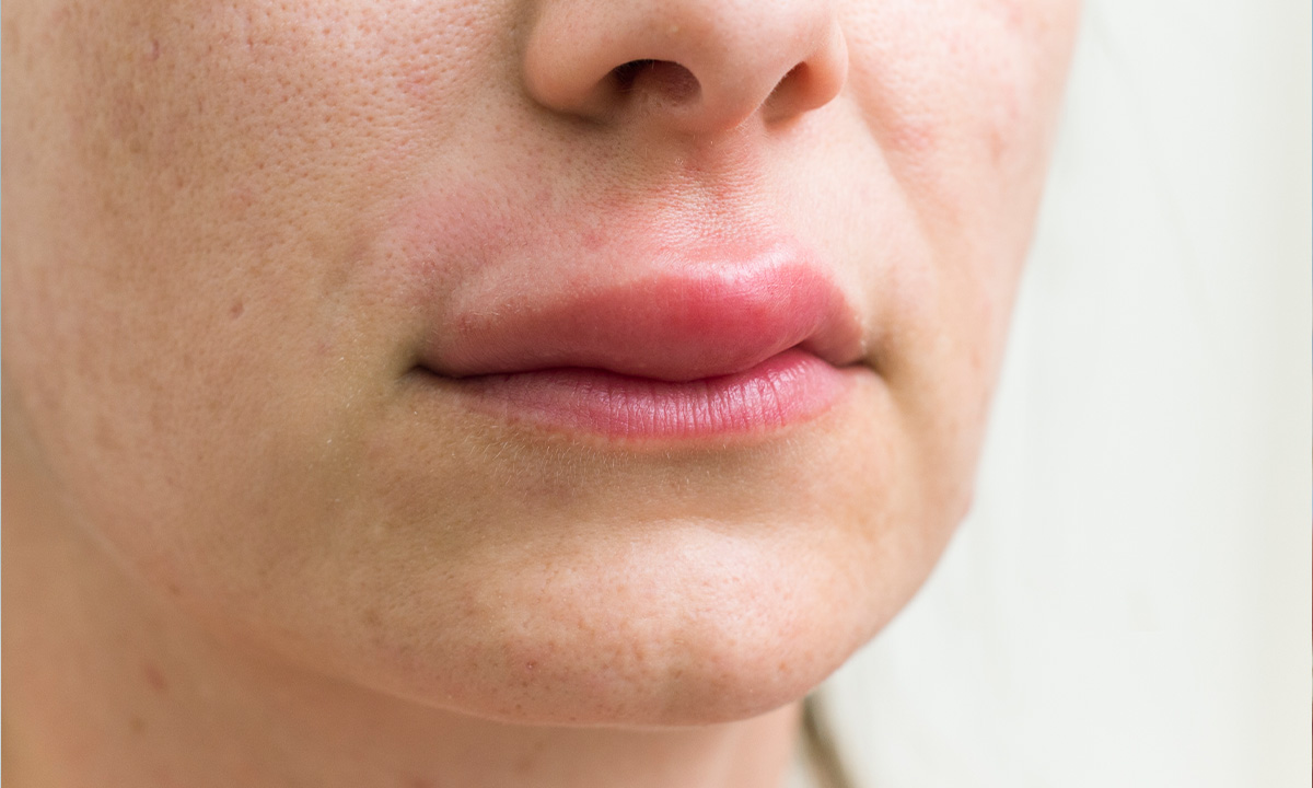 Lippenschwellung